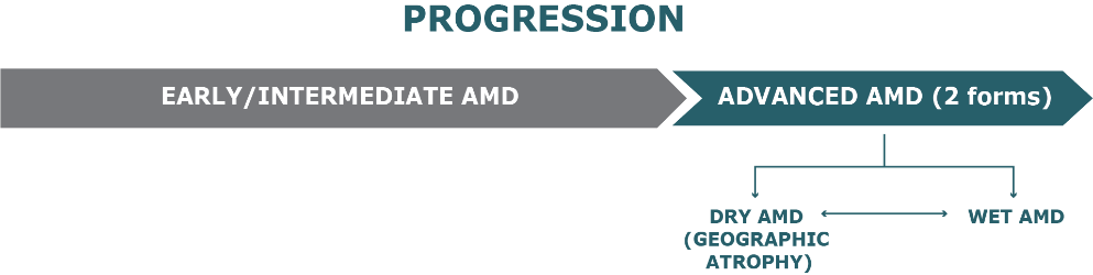 Diagram of progression from early to advanced AMD