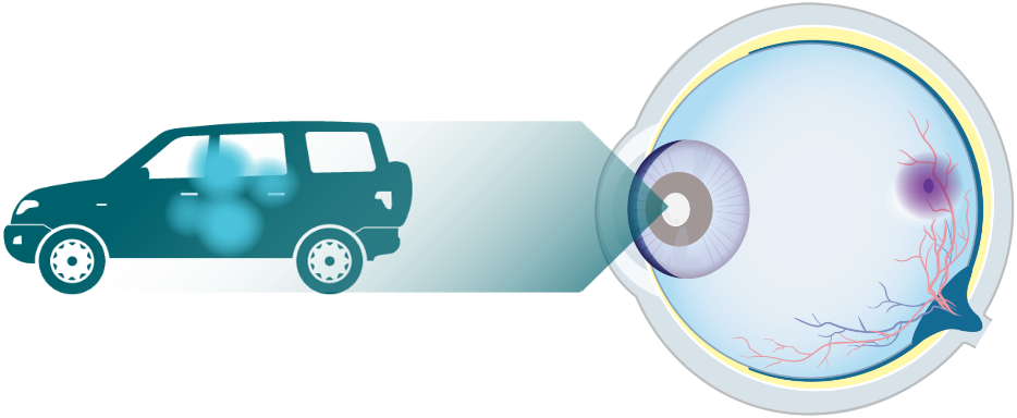 Eye diagram looking at a car with an illustration of visual impairment due to early/intermediate AMD