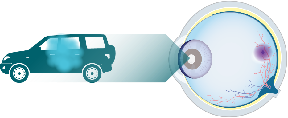 Eye diagram looking at a car with an illustration of visual impairment due to Geographic Atrophy