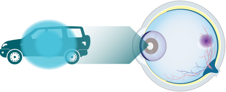 Diagramme d’un œil regardant une voiture avec une illustration de la déficience visuelle due à la DMLA humide