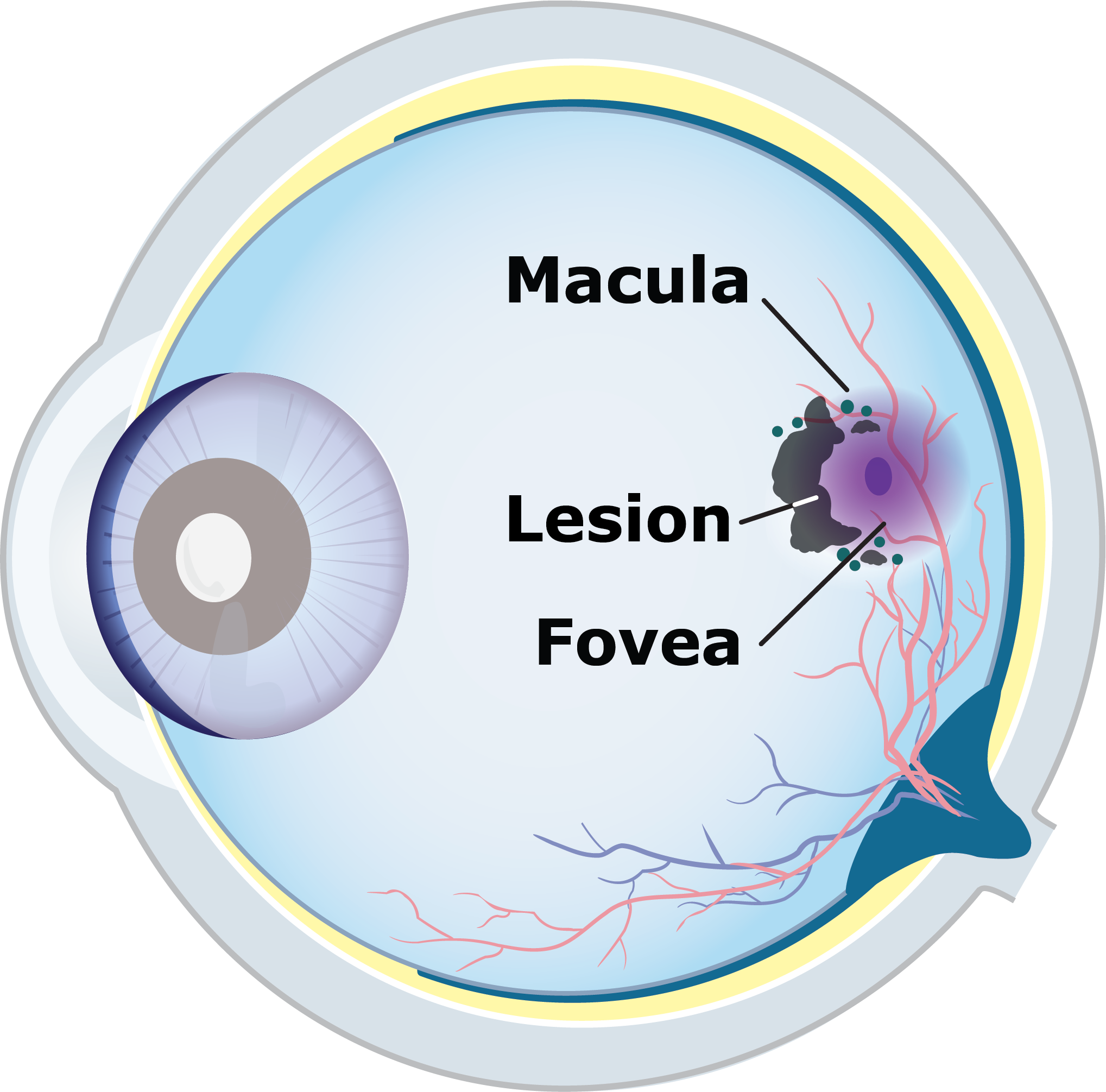 Eye illustration showing drusen and a small GA lesion over the macula