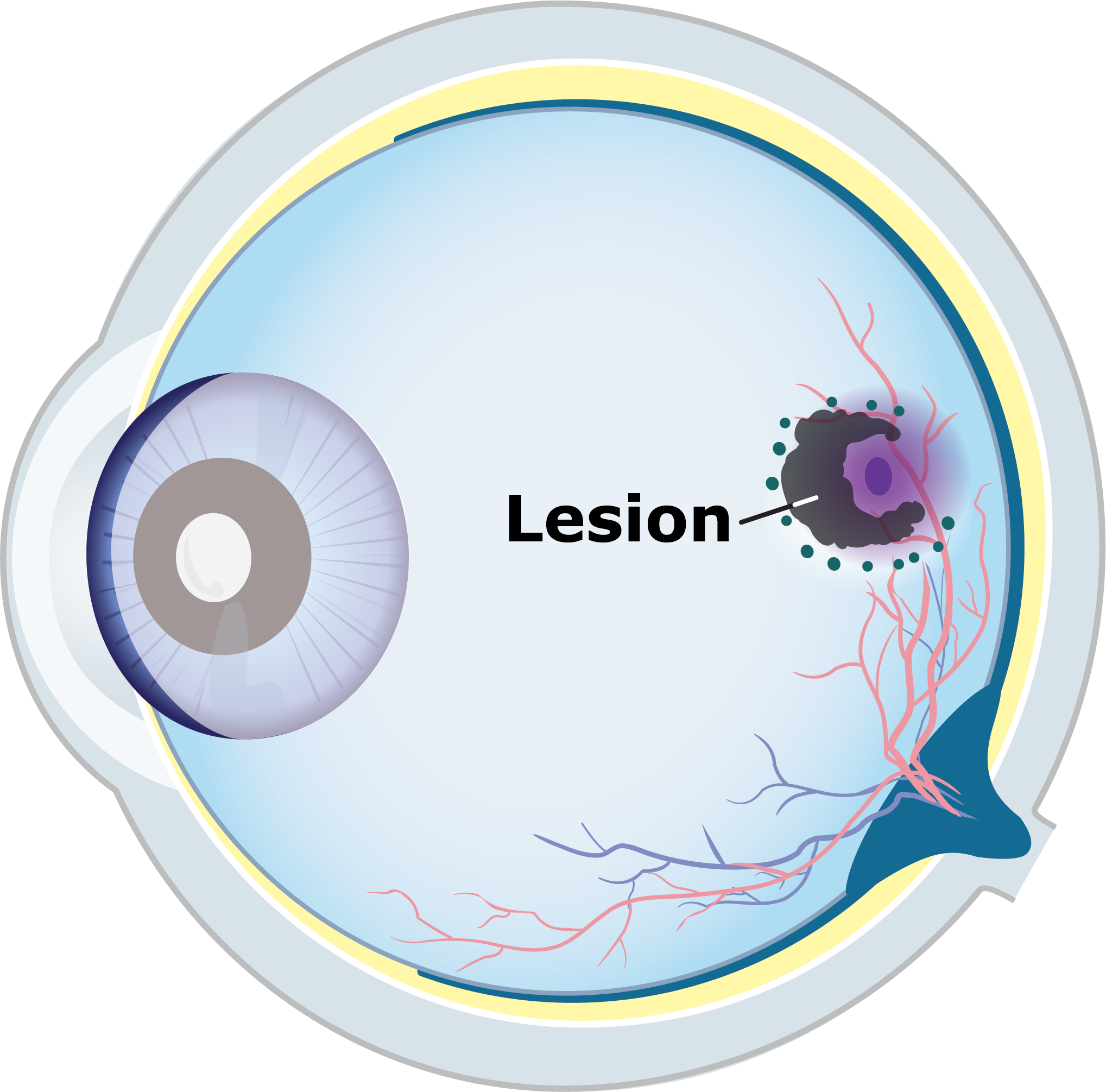 Eye illustration showing a larger GA lesion