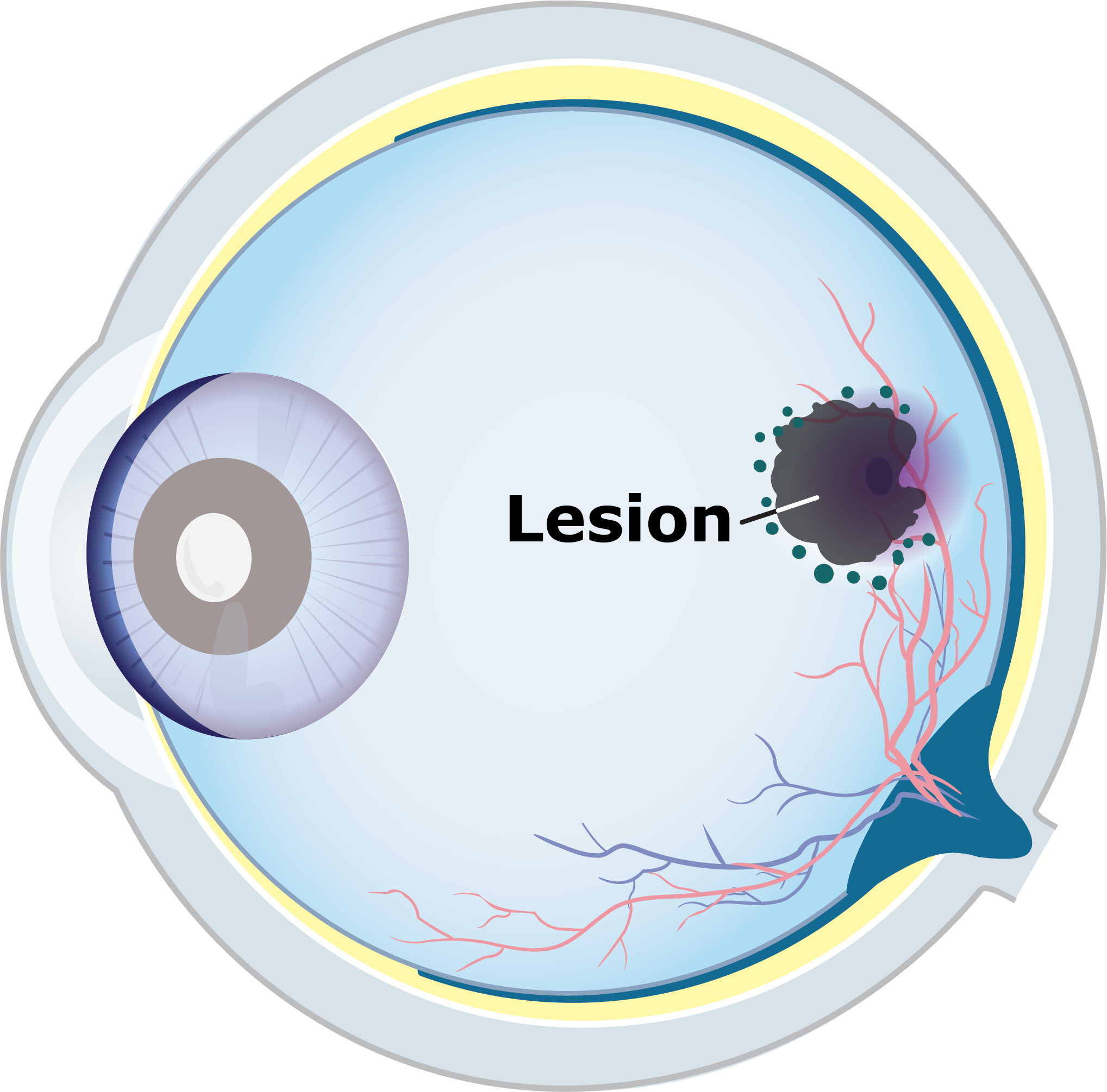 Eye illustration showing a large GA lesion that has covered almost all of the macula and fovea