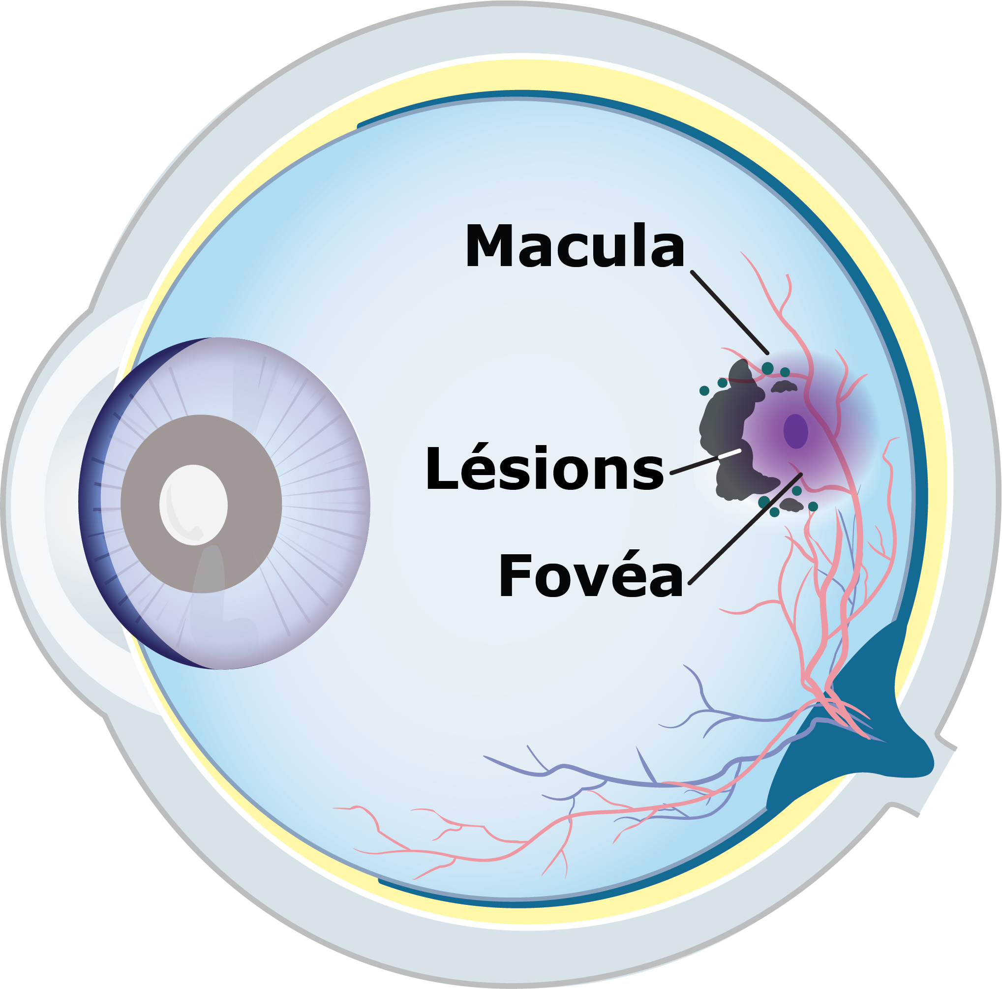 Illustration d’un œil montrant une petite lésion causée par l’AG sur la macula